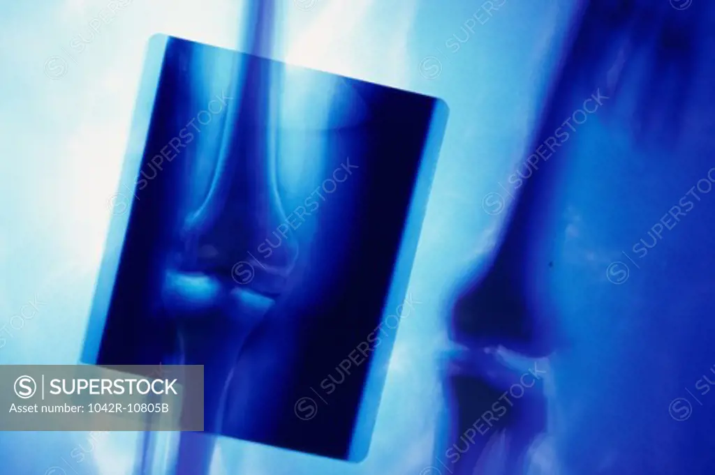 X-ray of a pair of human legs