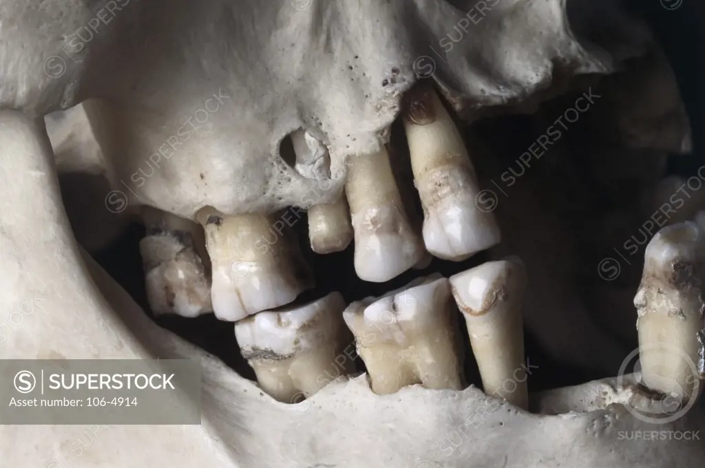 Close-up of rotting human teeth