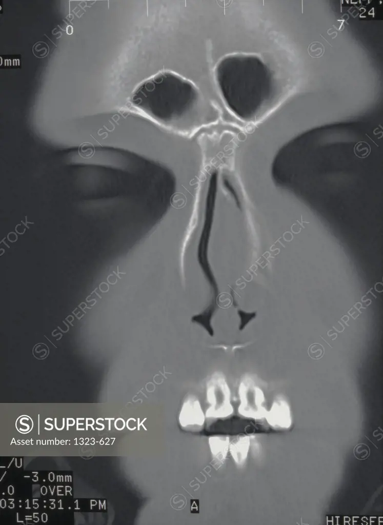 Close-up of an x-ray of a human face showing the sinus cavity