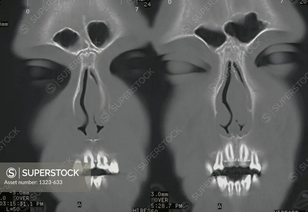Close-up of an x-ray of human faces showing the sinus cavity