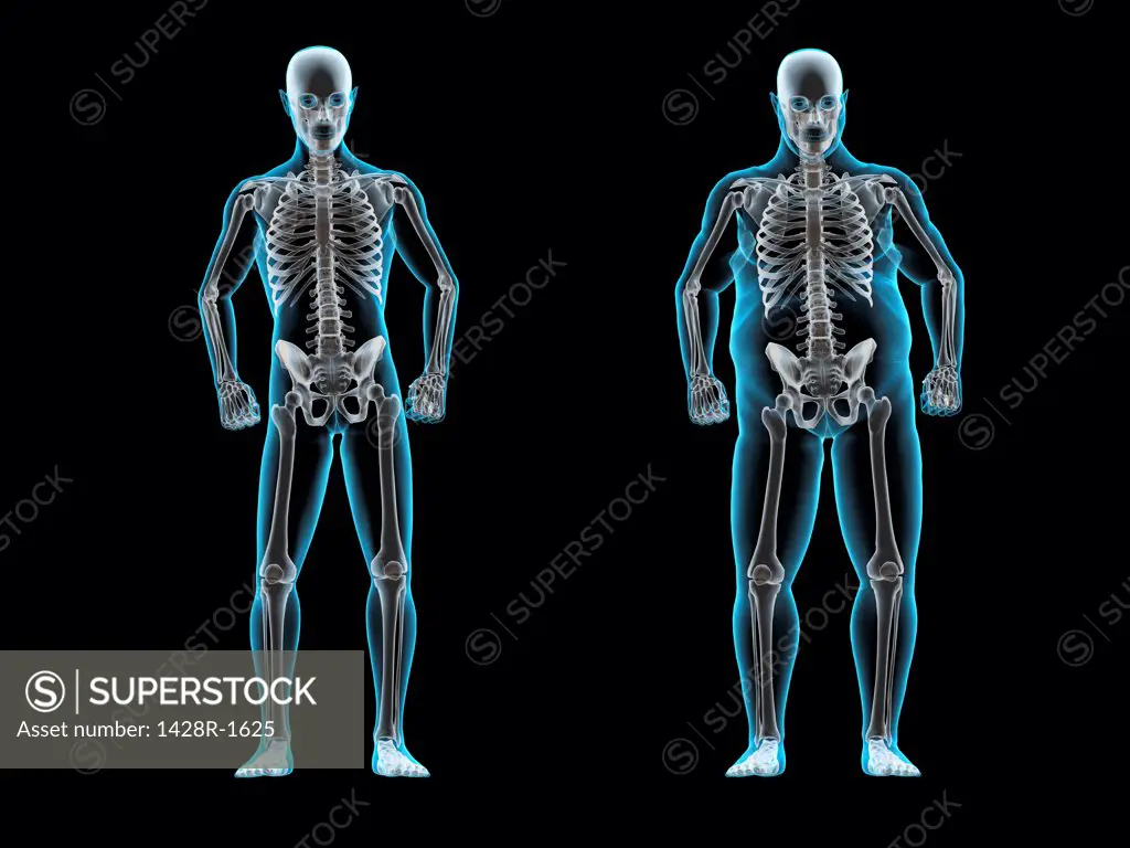 Thin and obese men, X-ray image