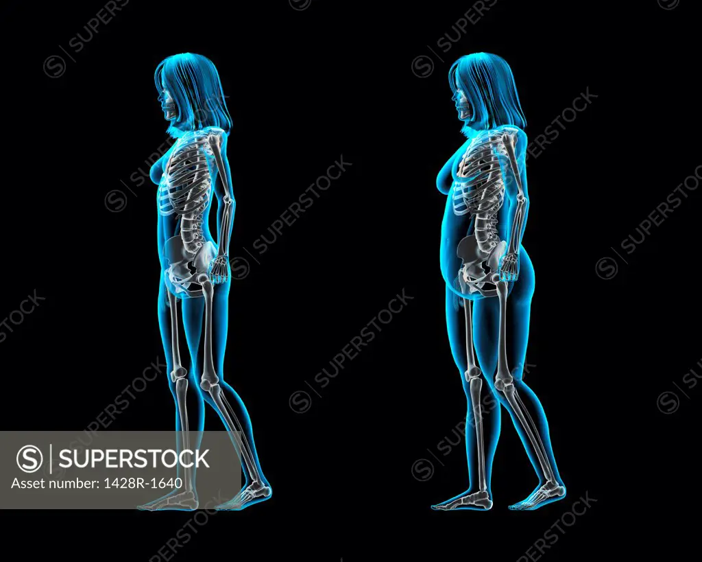 Obese and thin women posing in catwalk style, X-ray image