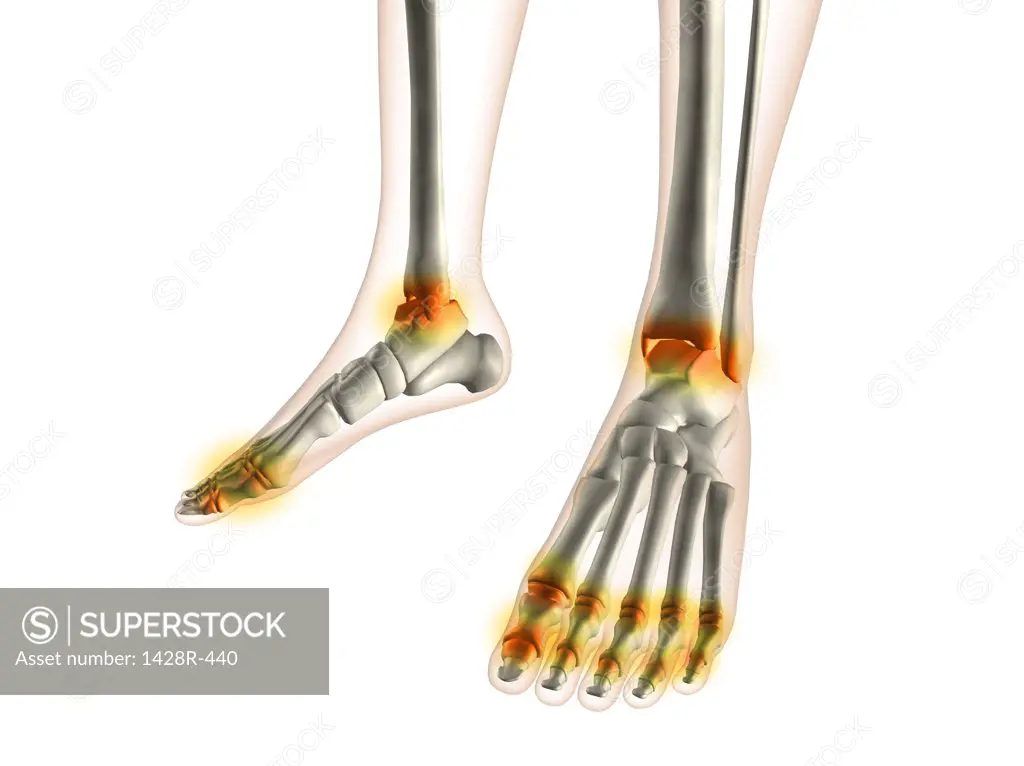 X-ray view of inflamed foot bones
