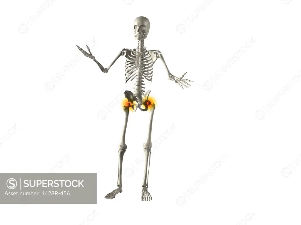X-ray view of a human skeleton with hip joint inflammation