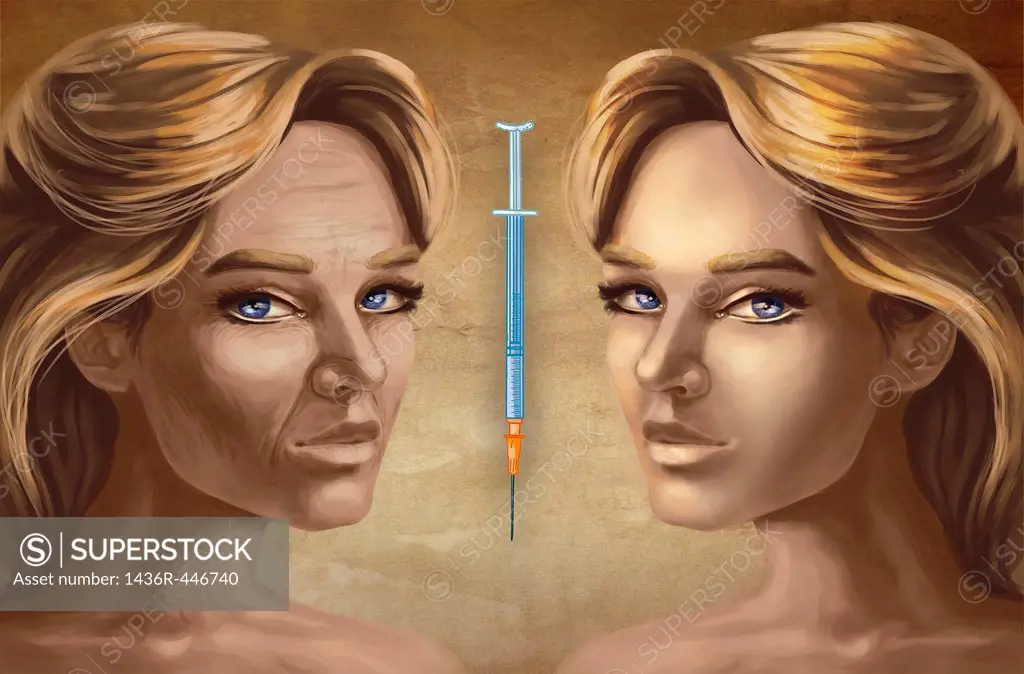 Female faces with Botox injection depicting effects after cosmetic surgery