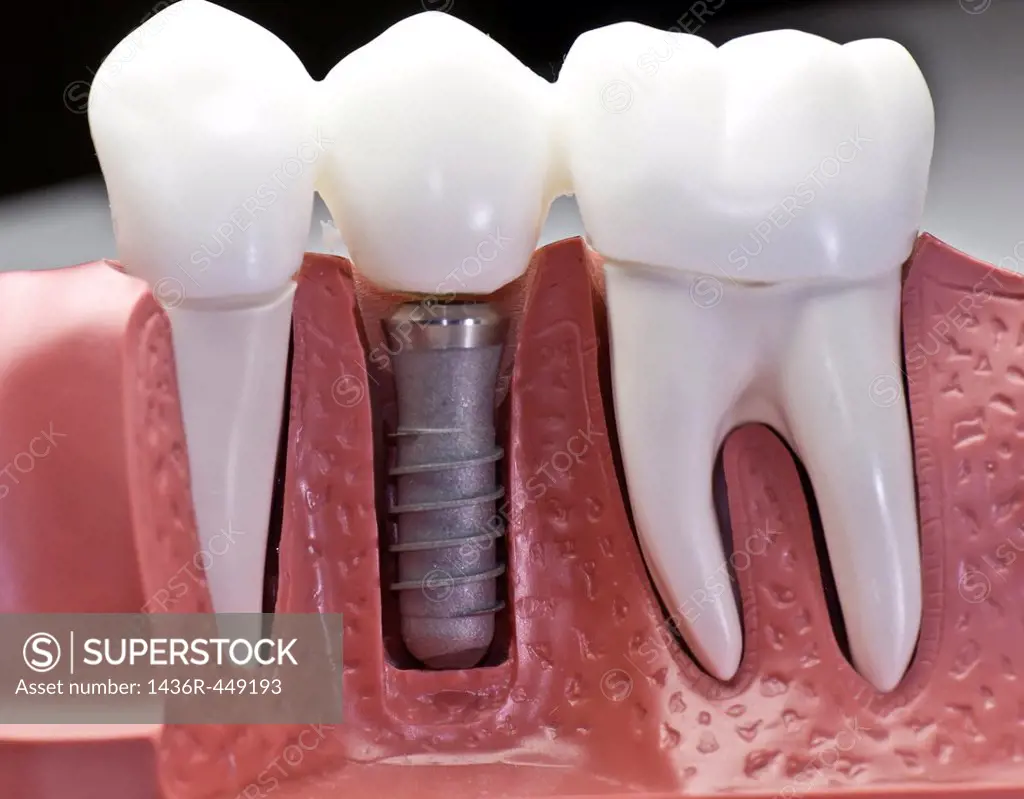 This model show the teeth have been capped and the stainless pin in the gums