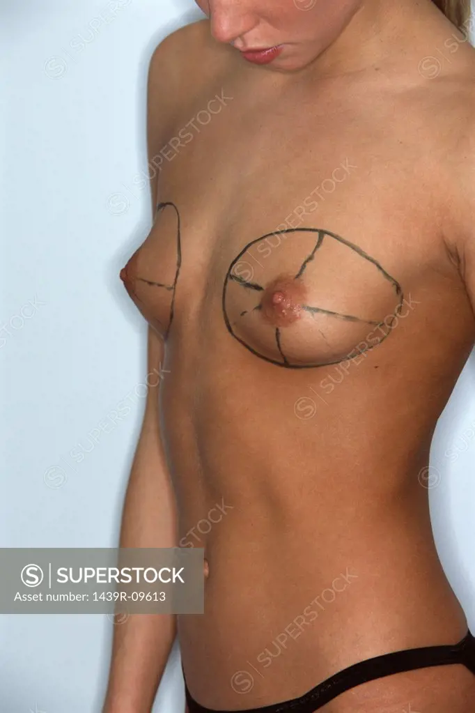 Woman preparing for breast implant operation