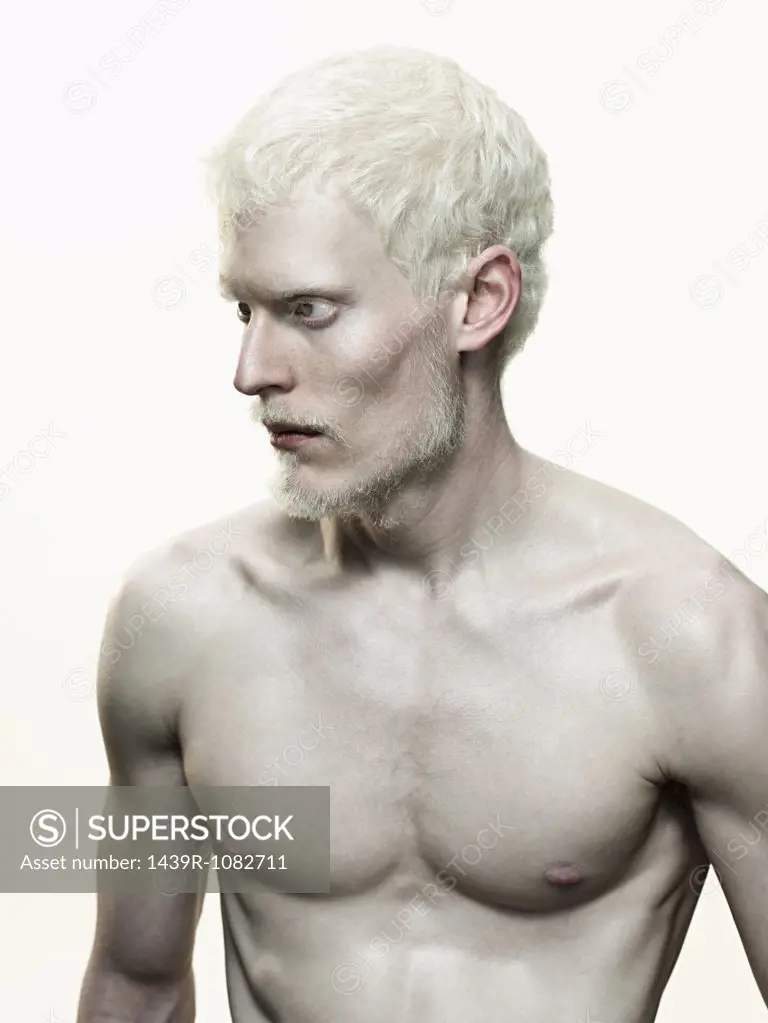 Albino man