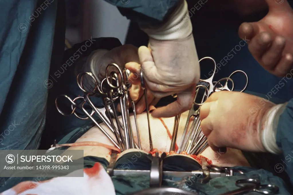 Surgeons performing a hysterectomy
