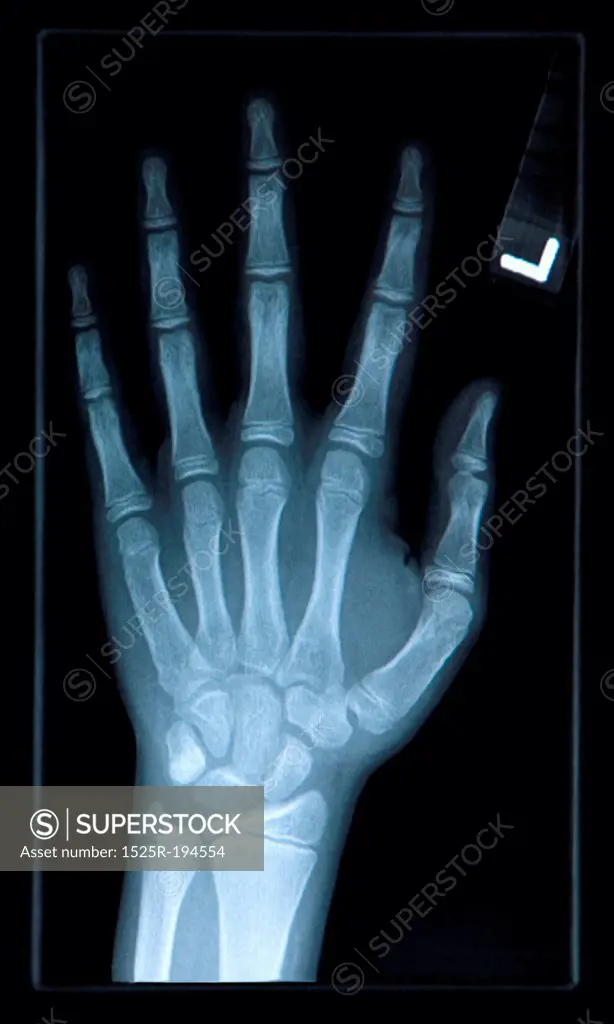 Close-up of xray of hand.