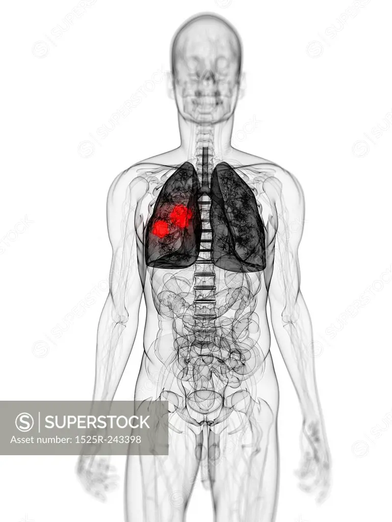 3d rendered scientific illustration of a lung tumor
