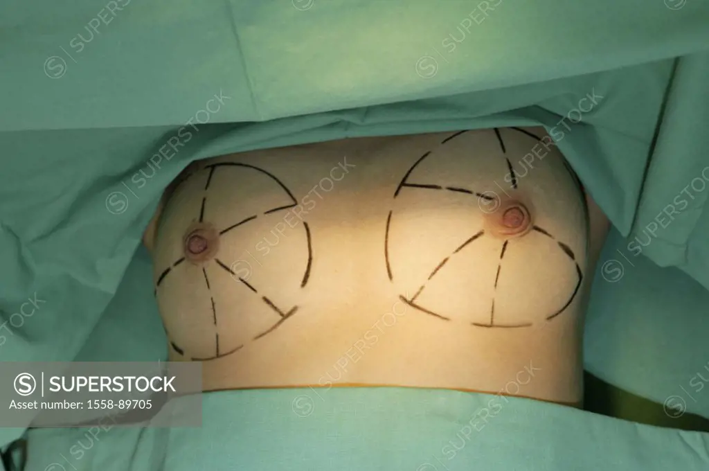 OP-Saal, female patient, detail, breasts, Markings, breast enlargement,   Series, plastic surgery, female patient, bosoms, operation,  Beauty operatio...