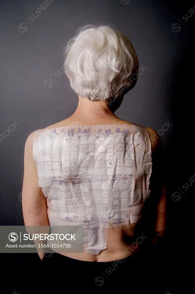 A woman patient´s back is covered with the patches of an Chemotechnique Allergan Series to determine specific allergic reactions  RELEASED