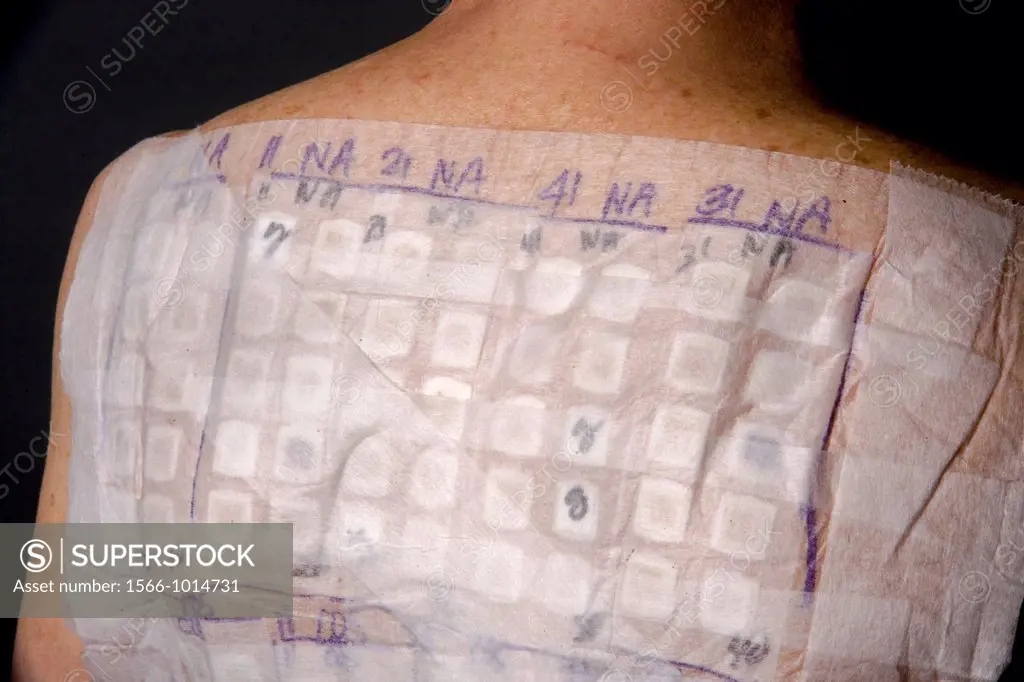 A woman patient´s back is covered with the patches of an Chemotechnique Allergan Series to determine specific allergic reactions  RELEASED