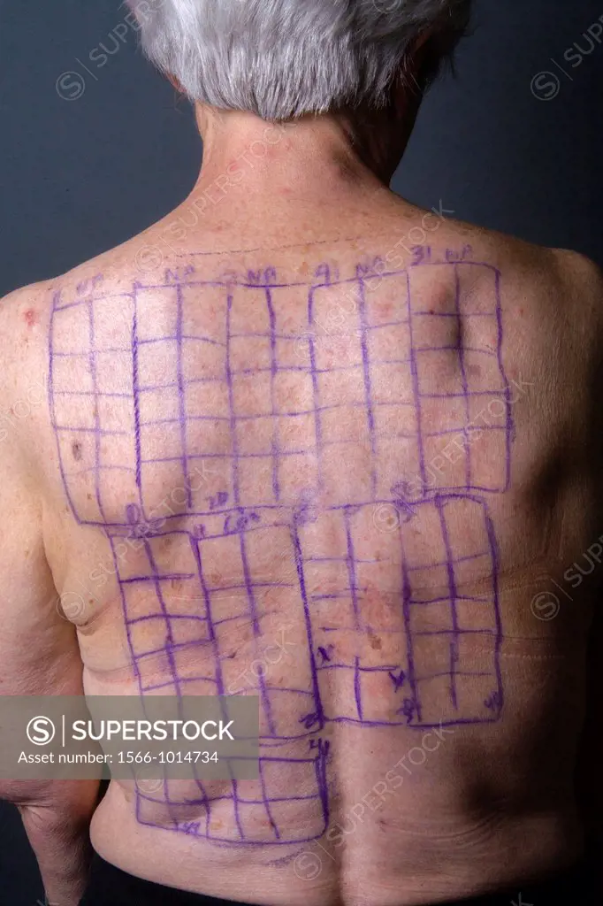 A woman patient´s back is drawn with squares indicating locations for the patches of a Chemotechnique Allergan Series to determine specific allergic r...