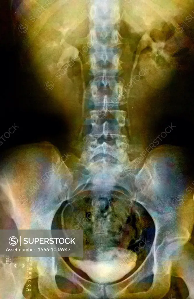 X-ray of the pelvis and lower back of a 25 years old woman  Light discopathy on L4-L5 and L5-S1