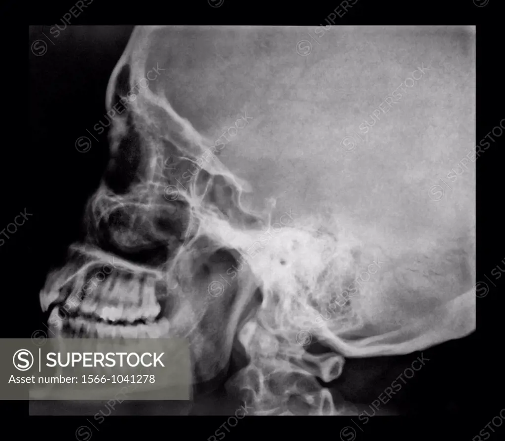 Facial sinuses  X-ray of the skull of a 42 years old woman, showing normal facial sinuses  Bilateral hypertrophy of the lower scroll bone