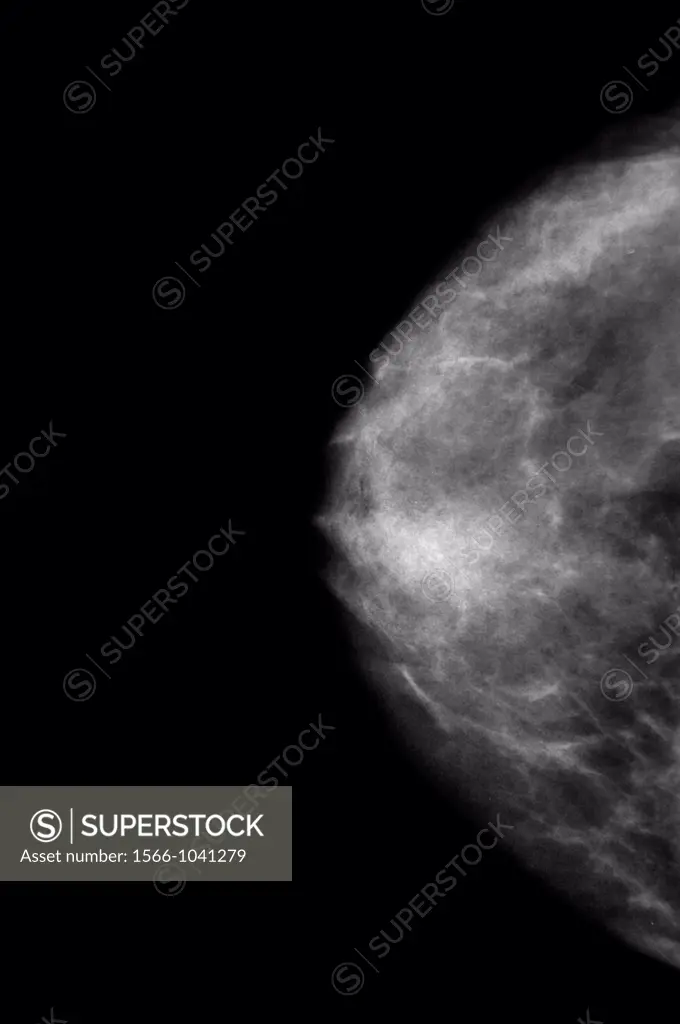 Mammography Normal breast
