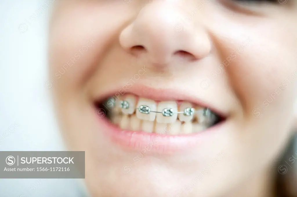 ortodoncia, primer plano de boca de chica adolescente con aparatos en los dientes, Orthodontics, mouth foreground teenage girl with braces on teeth,