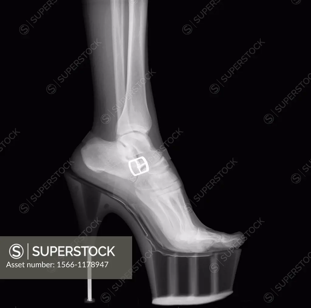 X-ray of a woman leg wearing Stiletto High-Heeled Shoe