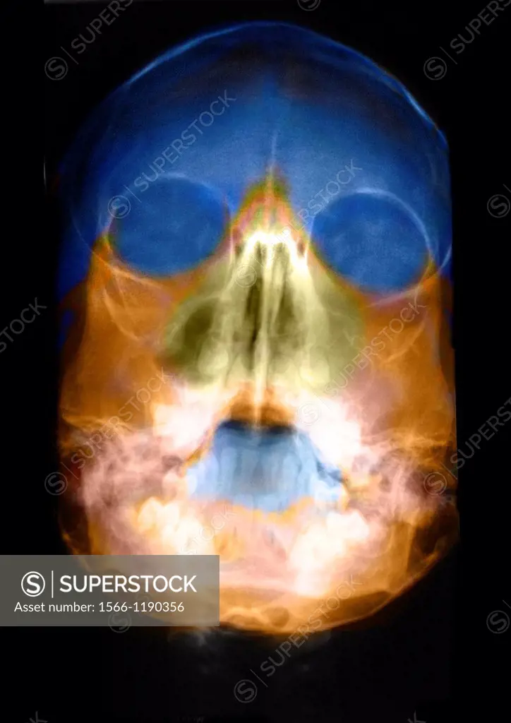 Skull radiography of a young girl  No anomaly detected
