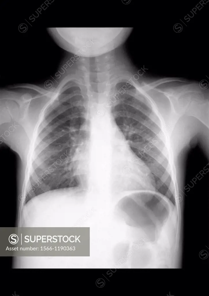 Normal lung radiography of a small girl