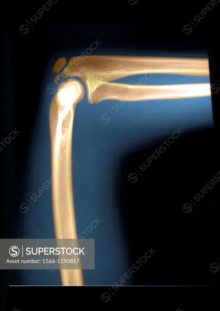 Delay bone age 15 years old child mesearing 1meter 48 high which correspond to the size of a 13 years and 4 months old child  The bone age is calculat...