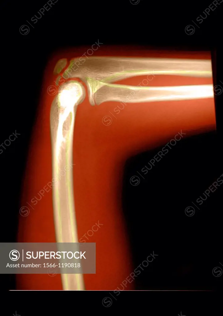 Delay bone age 15 years old child mesearing 1meter 48 high which correspond to the size of a 13 years and 4 months old child  The bone age is calculat...