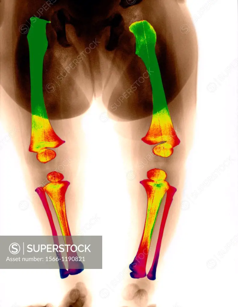 4 months years old child leg radiography  Looking for a morphologic anomaly between the legs  Here on the xray, no anomaly detected