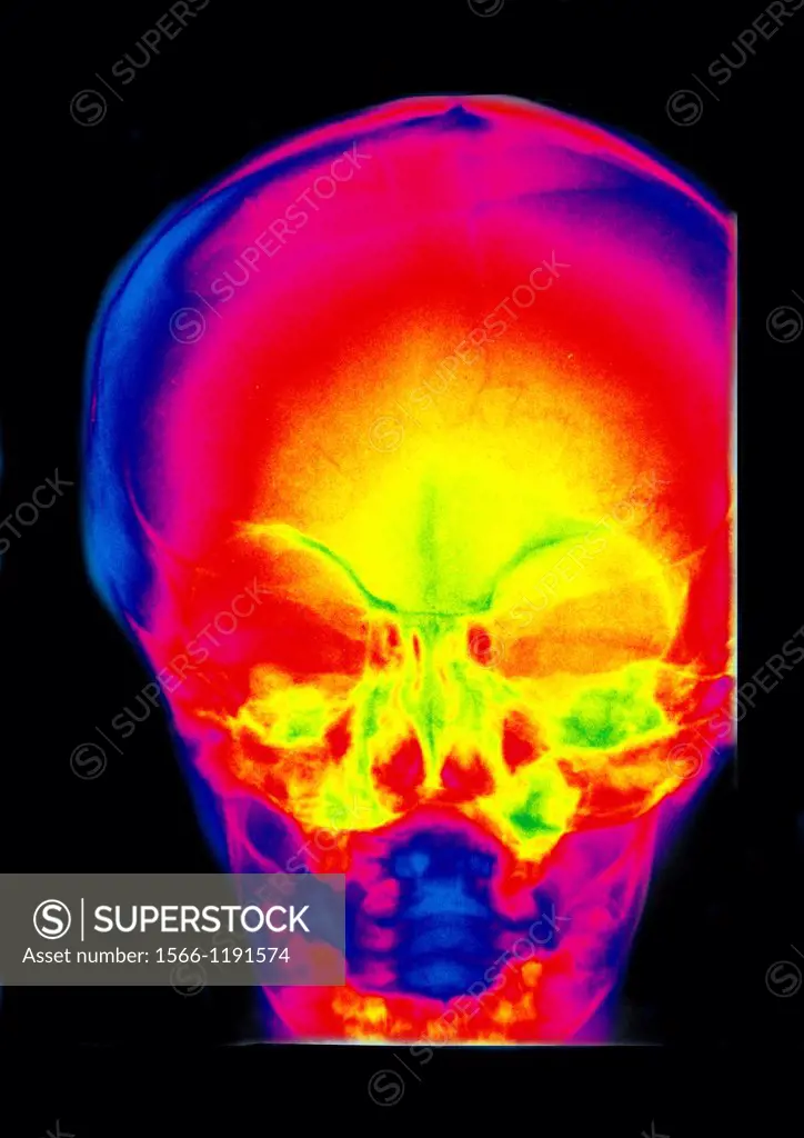 Sinus x Ray of a young child  Normal