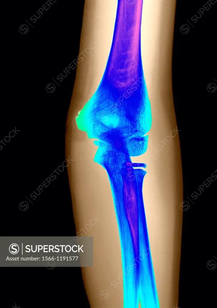 Calculation of the bone age with a radiography  12 years old child elbow radiography  Normal