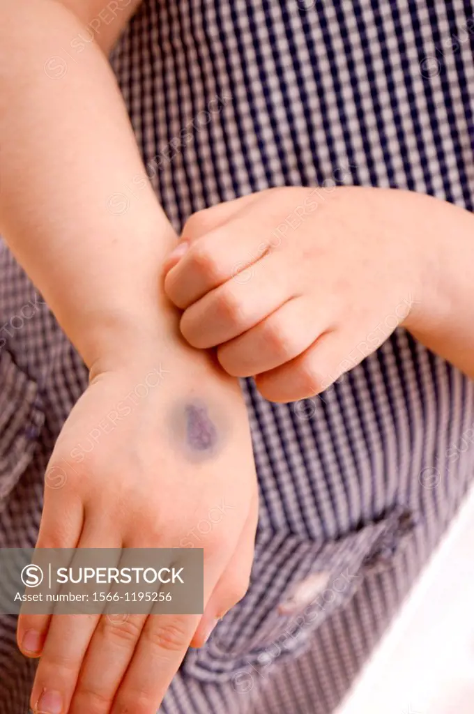 Children with hematoma on her hand