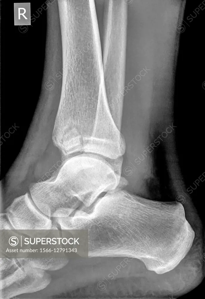 X-ray of an ankle 50 year old male with a fractured tibia. Side View.