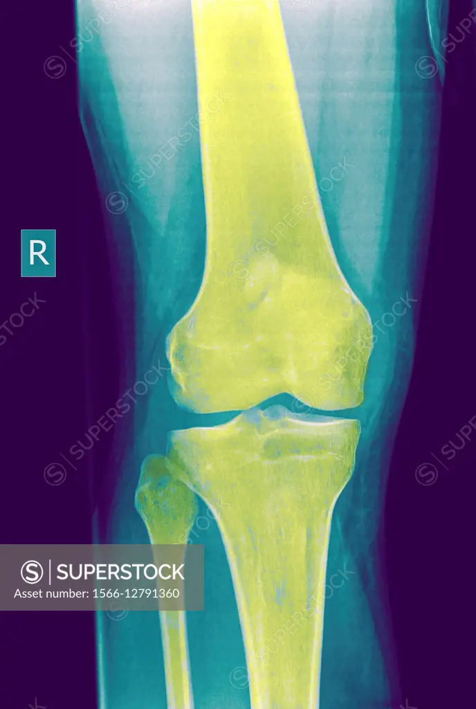 Knee x-ray of a 27 year old male patient front view.