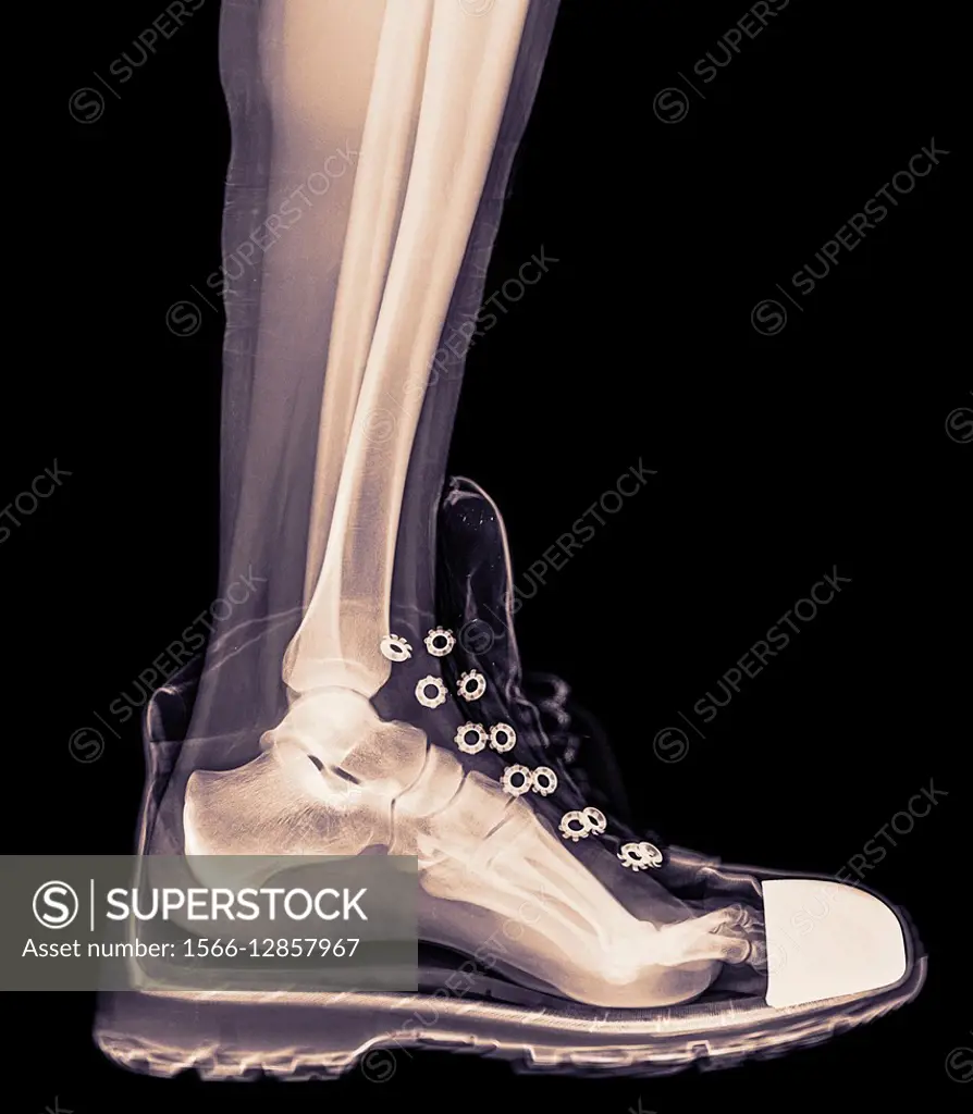 X-Ray of a foot and ankle in a running shoe.