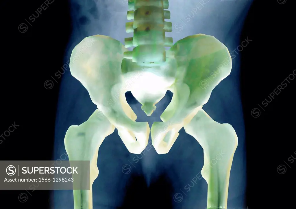 X ray of the hip of a 6monts old girl. Normal.