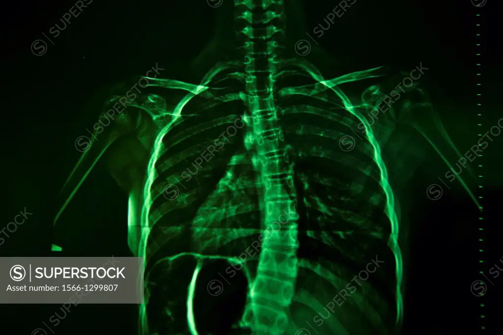 Scoliosis, spine radiograph