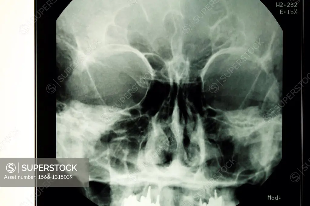 Radiography and medical imaging head, skull, mouth and dental implants, Isère, France.