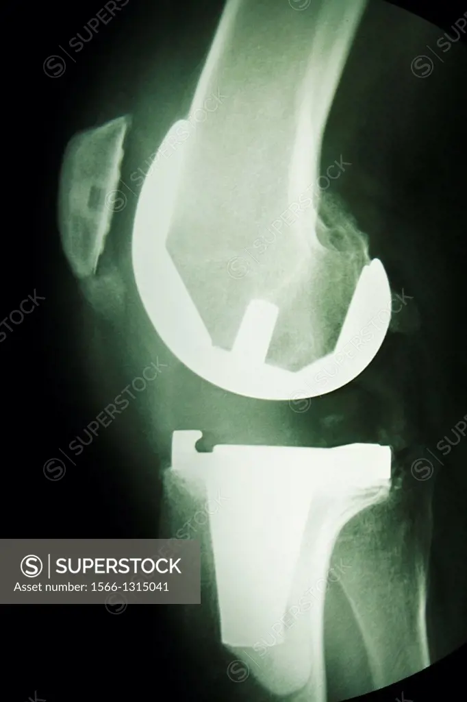 Radiographic knee prostheses, Isère, Rhône-Alpes, France