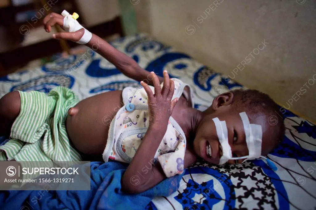 malnourished child at MSF hospital in central african republic.