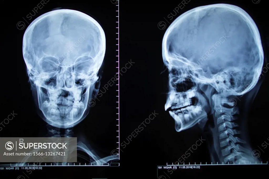 X-ray of a human head.