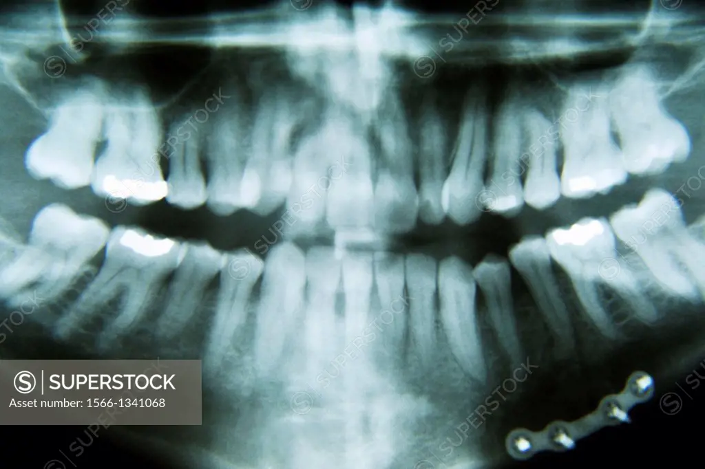Panoramic X-ray of jaw fracture repair.