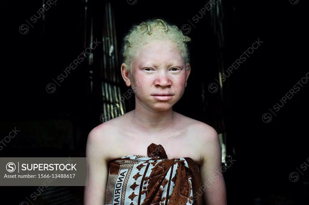 Albino girl at home. At Mananjary ( Madagascar).