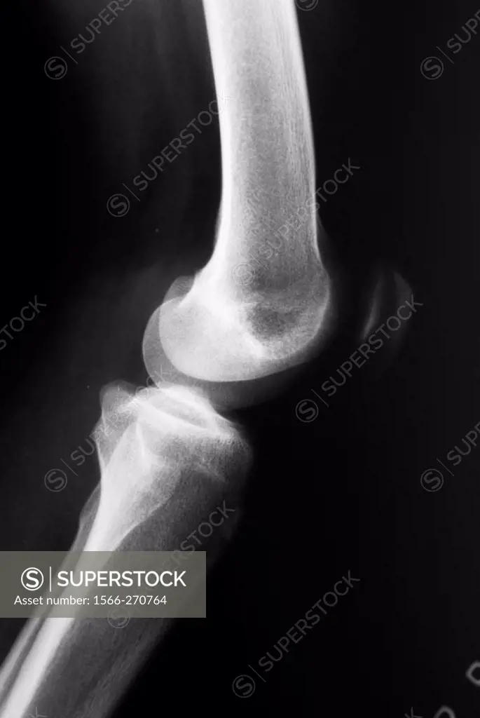 X-Ray of knee