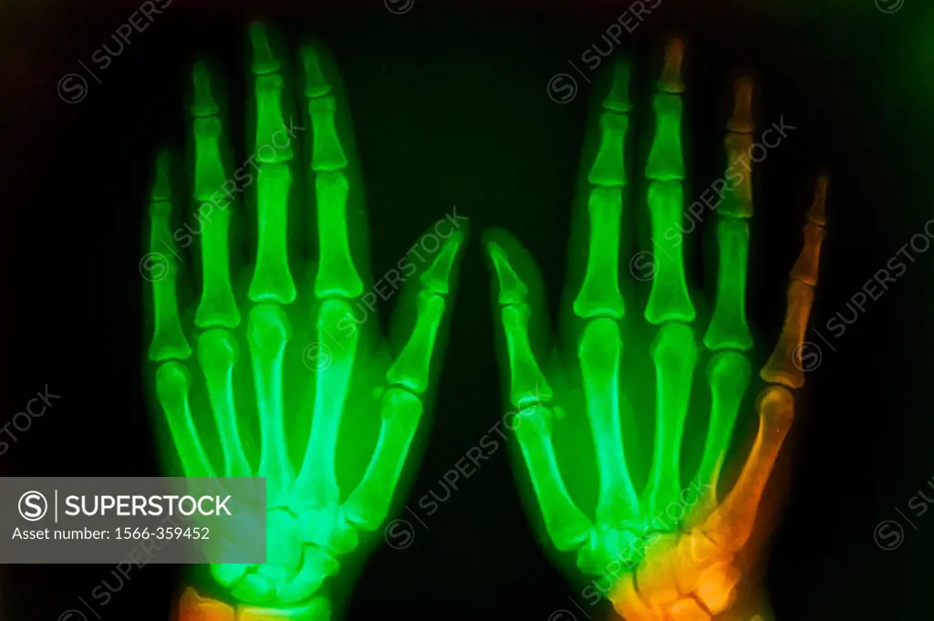 X-ray of hands