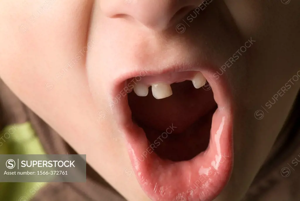 Boy´s mouth, missing tooth, 7 years old