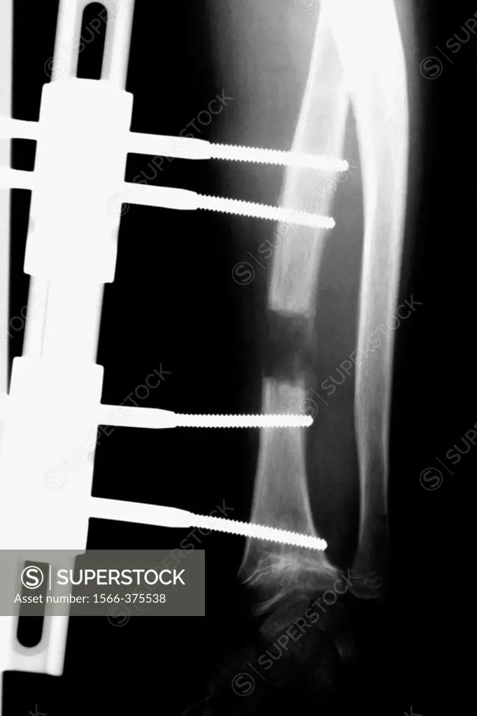 X-ray of arm with fixations for fracture.