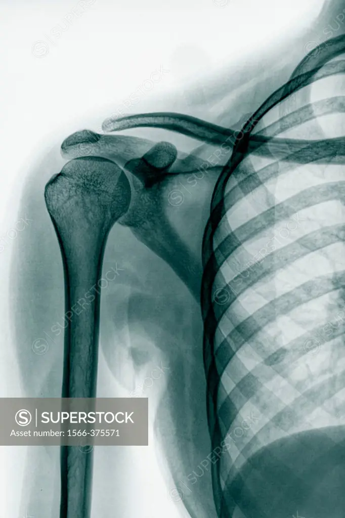 Shoulder bones X-rays.