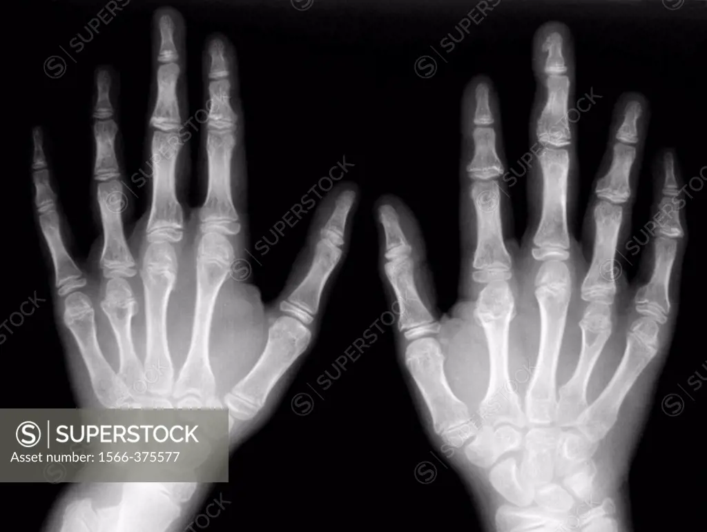 Hand bones X-ray.