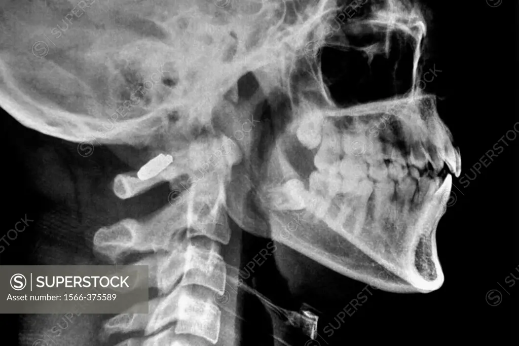 Cervical vertebrae X-ray.